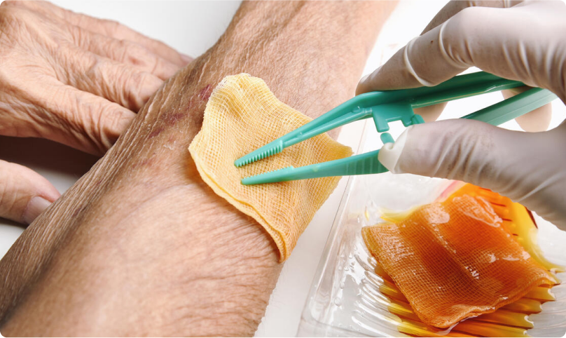 wounddressing wound dressing