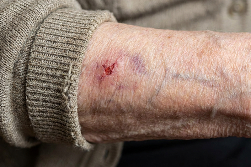 Minor wound on an elderly person's arm, showing fragile, bruised skin around the injury
