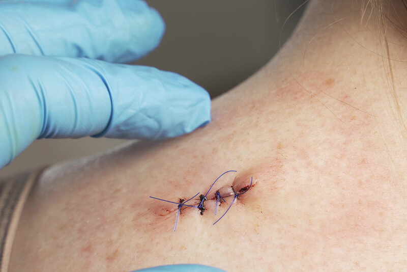 Backliners providing home wound care for surgical wound in Selangor and Penang