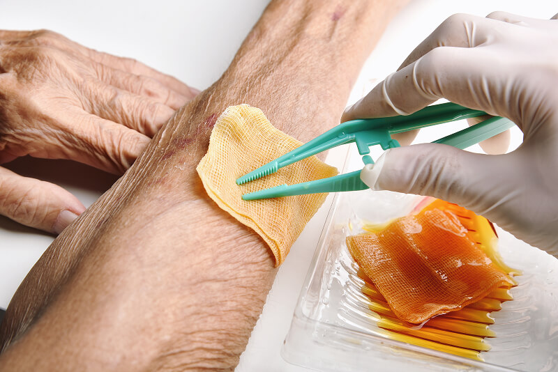 Diabetic foot wound care with professional dressing