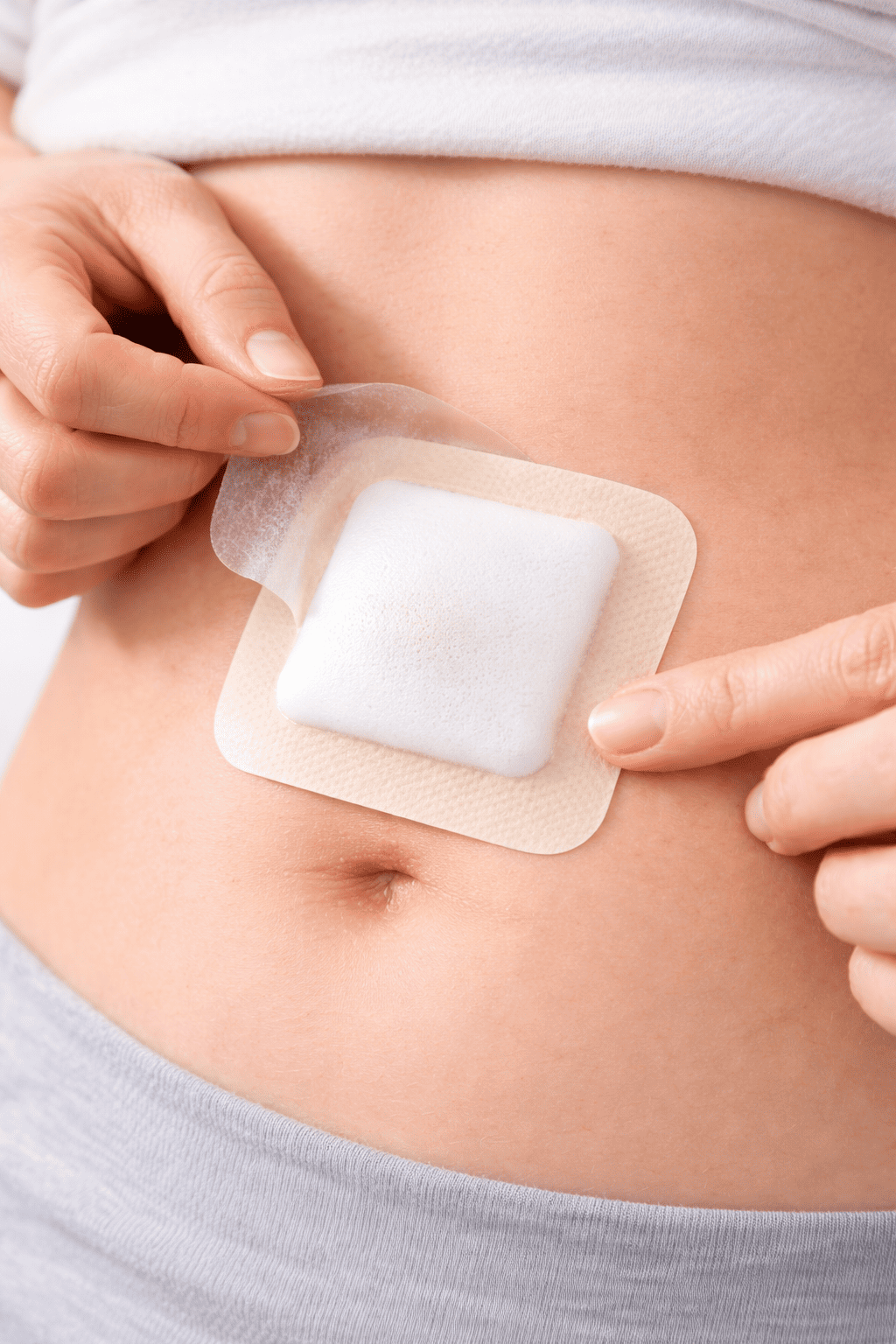 Applying foam dressing to an abdominal wound (1)