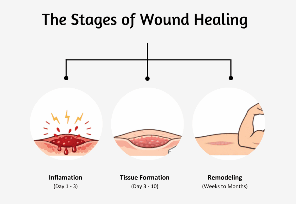 The Stages of Wound Healing
